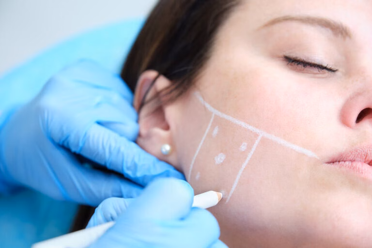 Botox Injektionspunkt